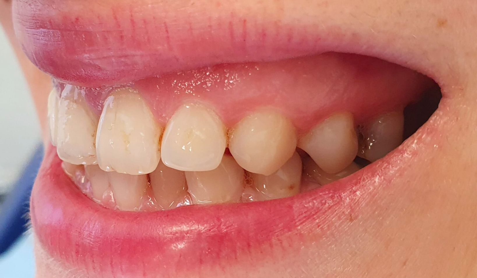 Composite Bonding Dental Art Implant Clinics